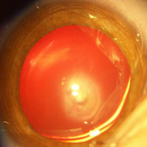Catarata de Mittendorf (sem vascularizao fetal associada)