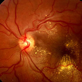 Doena de Coats (exsudao retiniana). Cortesia Dr V Rosas