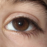 Microcrnea (olho direito)