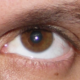 Hipertropia (olho esquerdo)