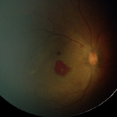 Hemorragia macular neonatal.
