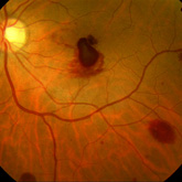 Hemorragia retiniana leucmica. Cortesia Dra S Penas