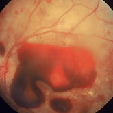  Hemorragia retiniana leucmica. Cortesia Dra S Penas
