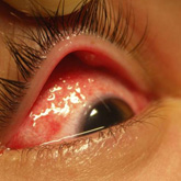 Enfisema subconjuntival - traumatismo ocular