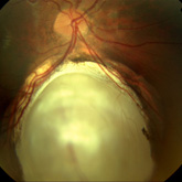 Coloboma da retina e coroide