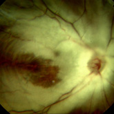 Gliose da retina