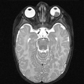 Retinoblastoma (ressonncia magntica)