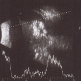 Retinoblastoma (ecografia)