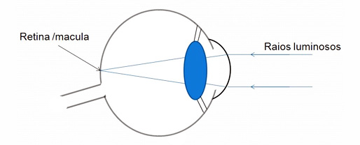 Emetropia: os feixes luminosos focam na retina